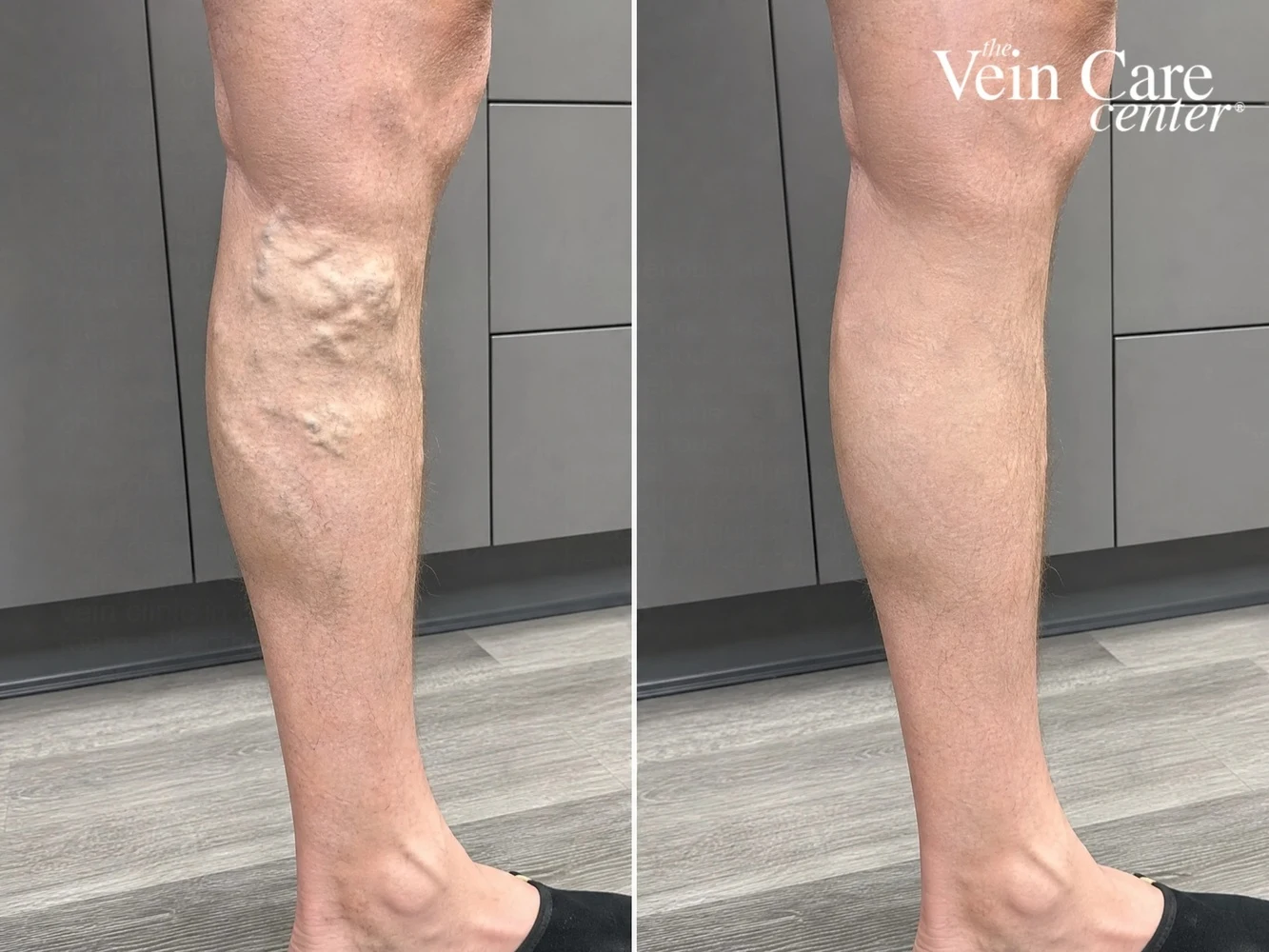 Before and after leg vein treatment showing reduced spider veins