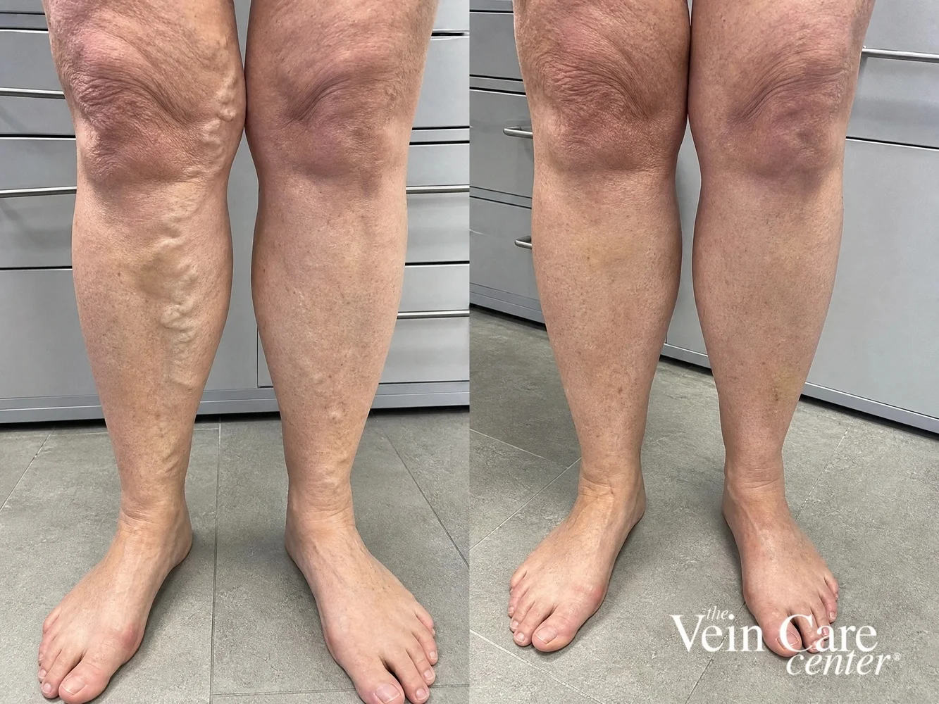 Before and after leg vein treatment showing improved leg appearance